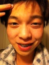 this is what i have. my double eyebags due to eyelids
