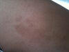 hyper-pigmentation now, no improvement in over 6 months even with hydroquinone