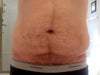 Loose skin hangs when I bend over or lay on my side.
