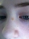 The light brown mole on my nose! ewww...!!!