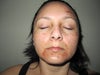 2 days after 1st treatment