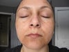 4 weeks after 1st treatment