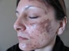 1 day after 2nd treatment