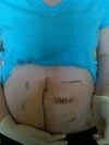 This was a photo after my last op. It was a colostomy reversal.