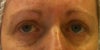 eyes pre surgery