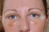 Eyes today post surgery