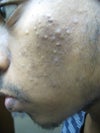 right cheek recently taken