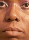 my nose now