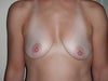 before surgery