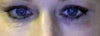 thin under eye skin
