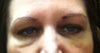 day 16 after botox juvederm