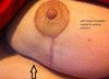 Left breast