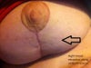 Right breast