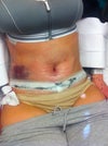 Post Op Day 1