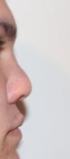I wanted a more "ski slope" nose or at least straight, but now the tip is just huge and looks like a big lump and I'm very unhappy with it