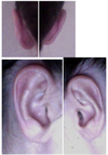 profile and back of ears after otoplasty