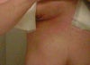 This is my left side. My right side does not display this. FYI doctor told me he took out "tremendous amount of tissue" yet my gynecomastia was not super severe more like mild case.