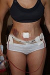 Post Op Day 4