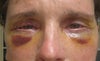 My eyes about 5 days after my surgery