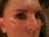 19months after surgery