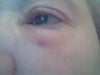 Left Eye after 1 week