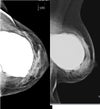 Left breast  / extracapsular rupture