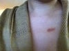 scar on my chest (red/shinny)