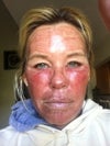 After laser peel