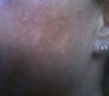 My face today... hyper pigmentation?
