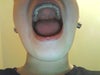 Use to be way wider till teeth started shifting inward