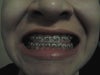 I have the tac on my molars to prevent me from knocking off a bracket (it happened once)