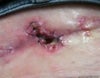 The hole as of yesterday. It was healing but ripped again
