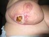 this is my breast now 4 weeks later. is this normal and why does is look like this? do u think its looking like its healing?