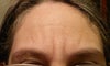 this is how it looked in january,  totally still, I am -not- frowning or moving. improvement is very slow. when will this go away.