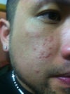 The Scar really Did Raise, But theres Brown Spots