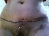 5 days post OP
