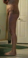 5 days post op