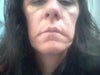 Indentation/crease on face