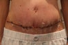 Day 12 Post Op Front View