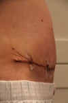 Day 12 Post Op Side View