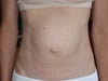 2.5 years Pre-surgery Front View