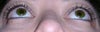 Hollowness under and sides of eyes