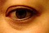 skin color bumps under eyes