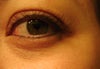 Wrinkles under eyes