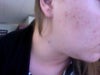 This is the worst area.  I still occasionally get a pimple or two, but it is mostly cleared.