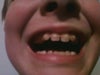 splinted teeth