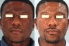 A before an after picture of a gentlemen who under went laser treatment. This is also what i would like to achieve as the noticeable difference in the texture an shade of the Before & After. The main difference is the transformation from the shade of his nose an how it compliments the shade on his cheeks, forehead, an chin on the After picture.