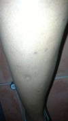 black spots on my legs