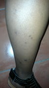dark spots on my legs