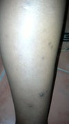 dark spots on my legs and they keep worsening